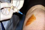 Synvisc injection into knee